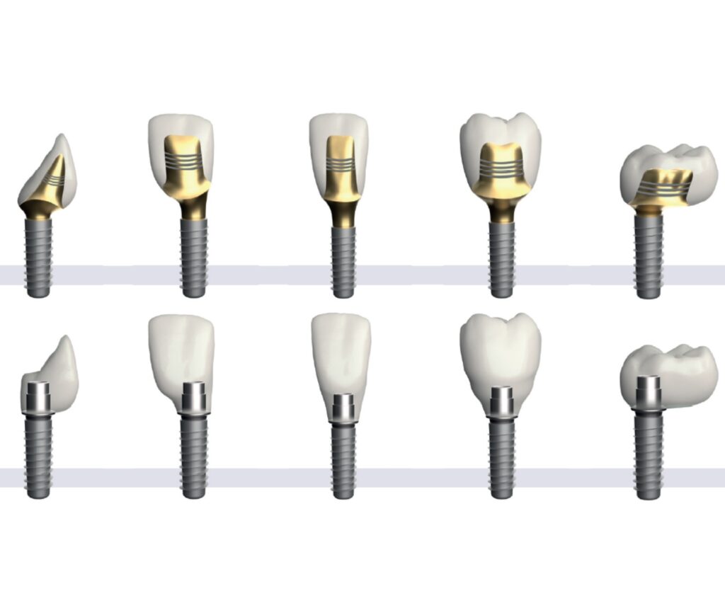 Customised & anodised CAD/CAM Innodema Abutments - Dental Labo Vanderbeken