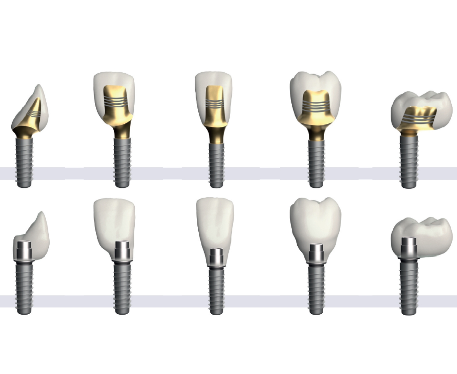 Customised abutments anodised