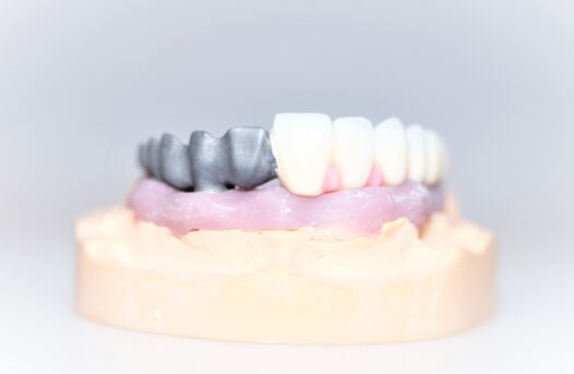 Implant bridge