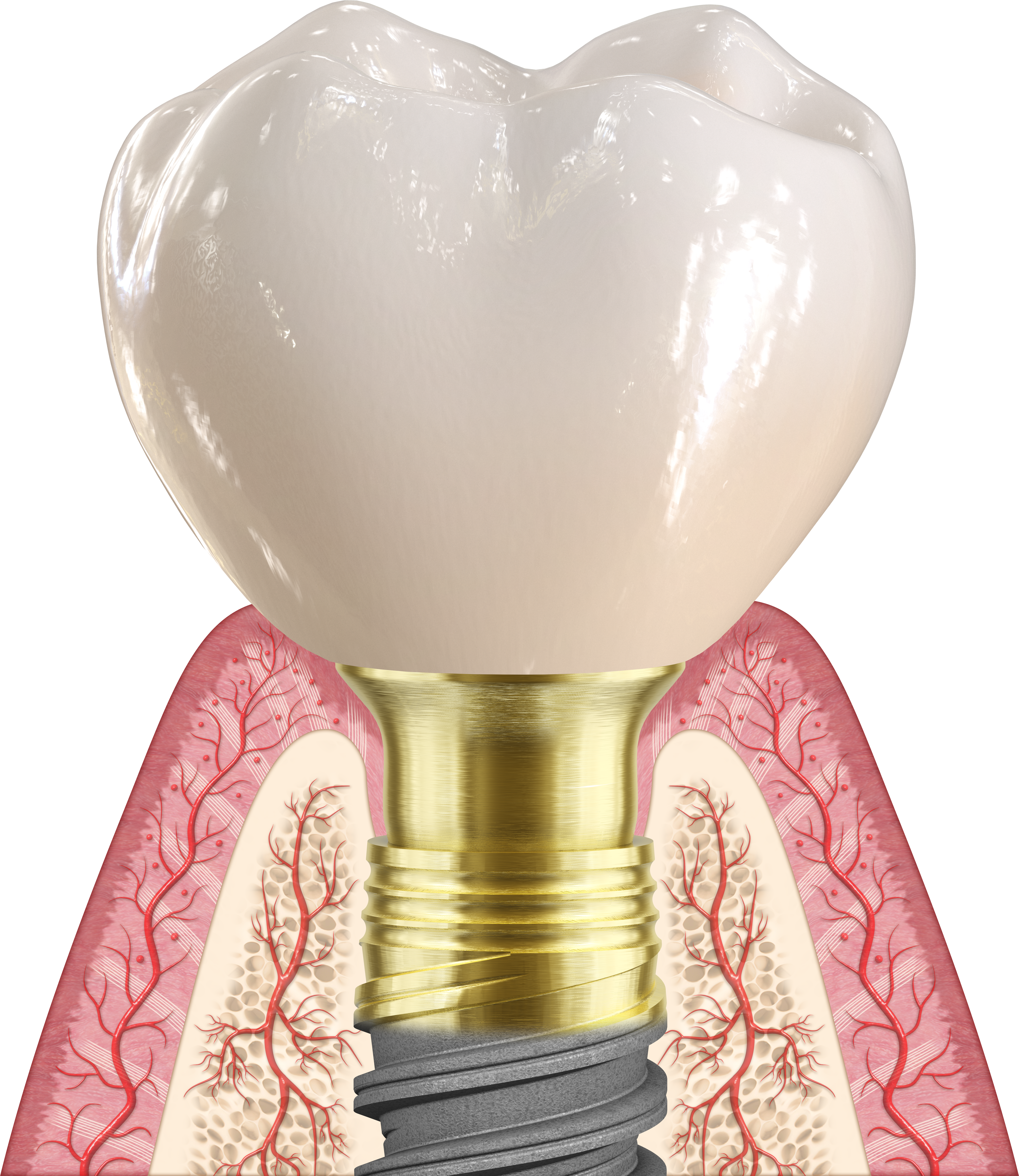 Nobel Biocare