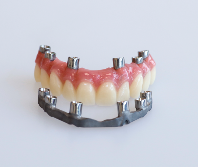 PMMA Brug met Gefreesde Titanium Versterkingsbaar TempBridge