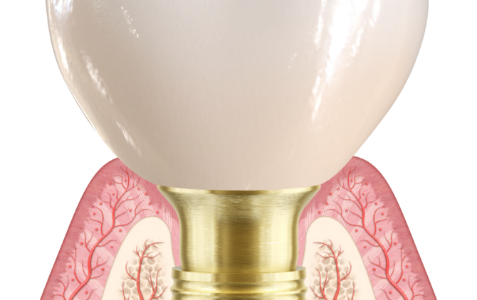 Nobel Biocare